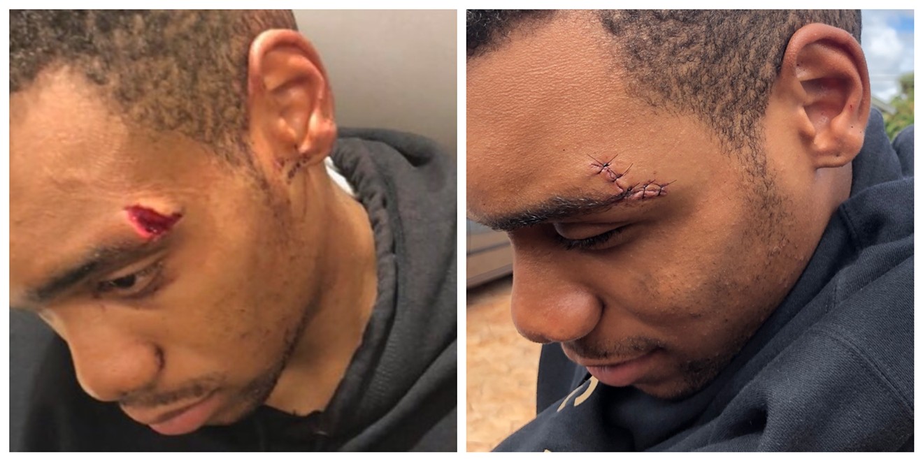 Jordan Bennett needed stitches after he says he was thrown to the ground by a deputy at Blanche Ely High School.
