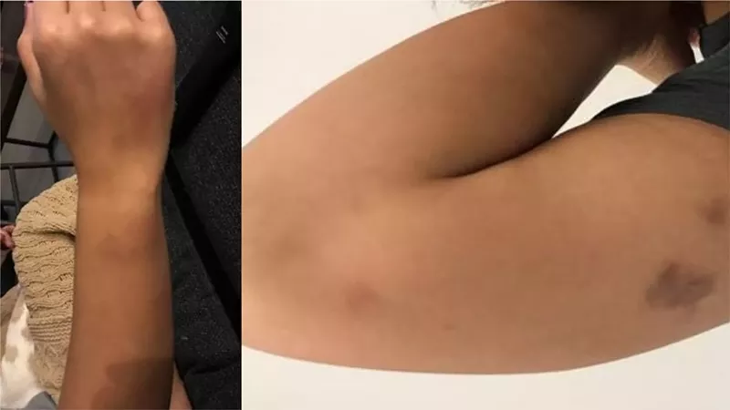 Image: Photos show Melissa Lopez with bruises on her arms and a bent, swollen wrist.