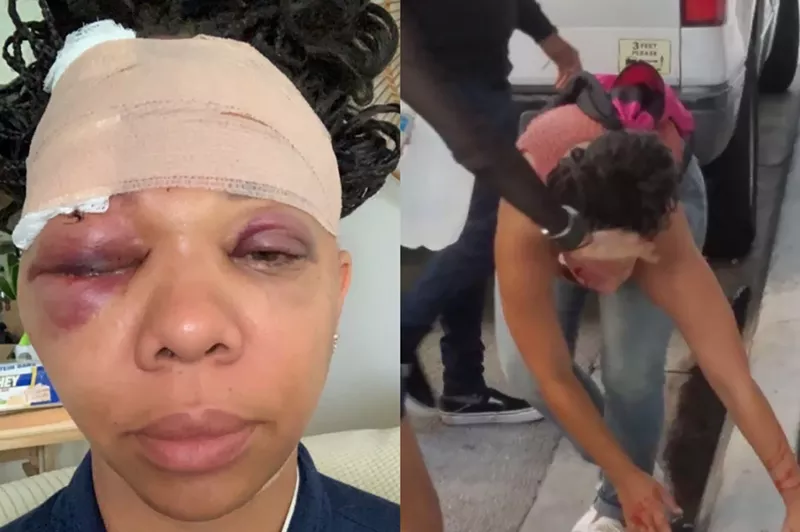 Image: SIde-by-side images of (left) LaToya Ratlieff's swollen face after she was struck by a rubber bullet and (right) Ratlieff bleeding after she was hit.