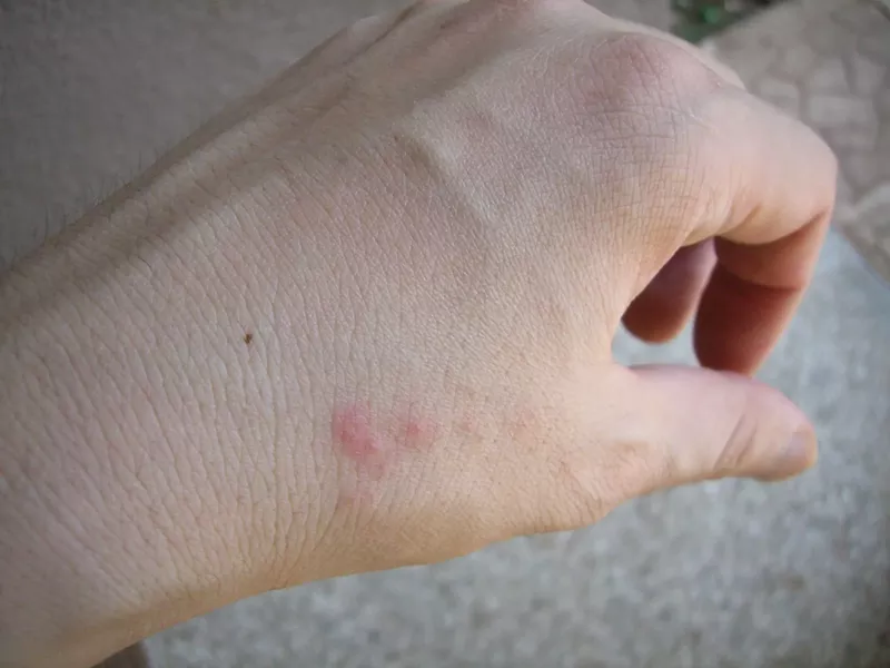 Image: a hand with red bug bites on it