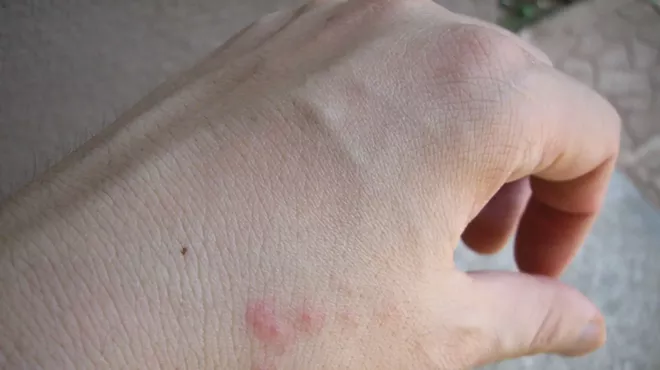 a hand with red bug bites on it